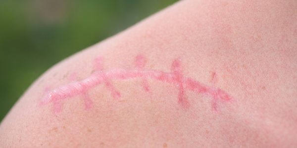 Scar tissue massage in Torquay and Surf Coast
